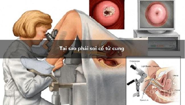 Soi cổ tử cung và những điều có thể bạn chưa biết